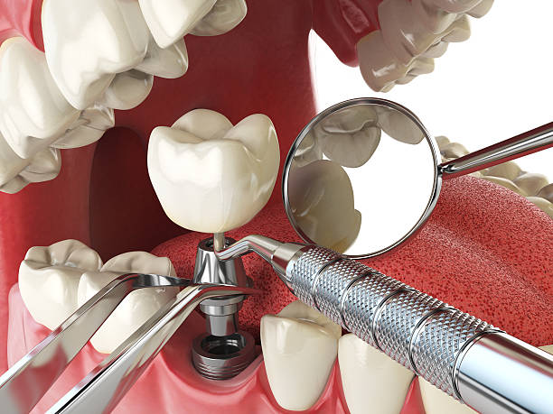 Best Emergency Root Canal Treatment in Rockwell, NC